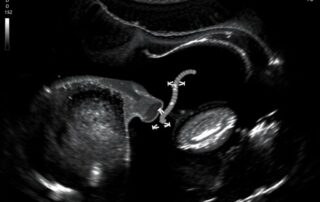 УЗИ мочевого пузыря: просто, понятно и без паники