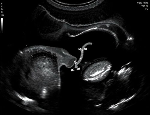 УЗИ мочевого пузыря: просто, понятно и без паники