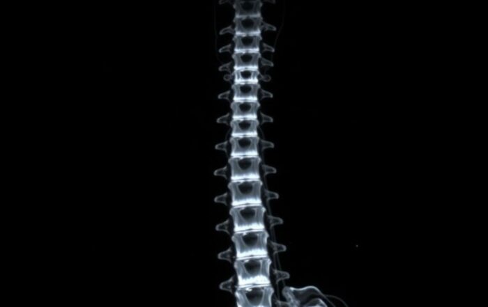 МРТ отделов позвоночника: что увидеть, как подготовиться и не потеряться в заключении